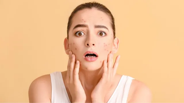 top-10-effective-tips-to-achieve-acne-free-skin-naturally-at-home-know-from-expert